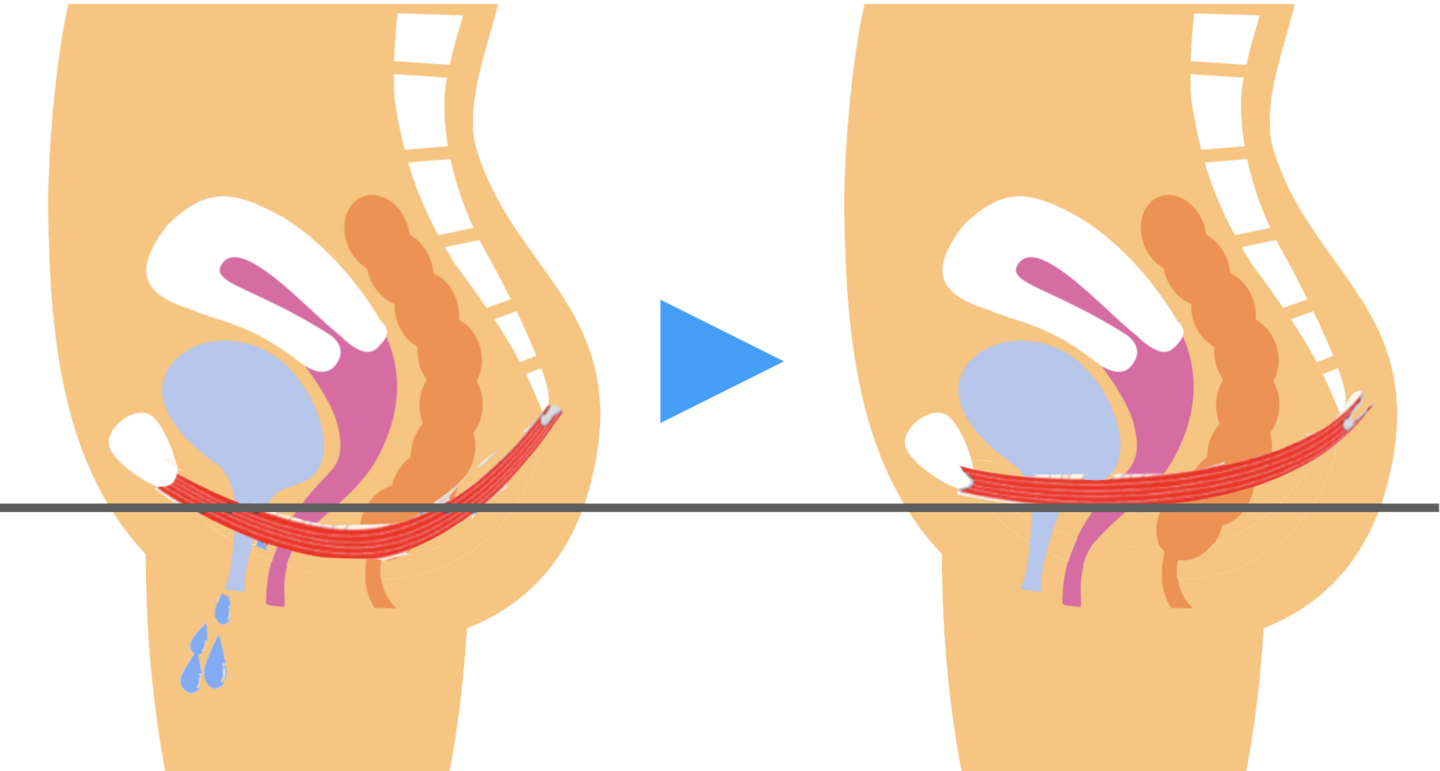 骨盤底筋の緩み
